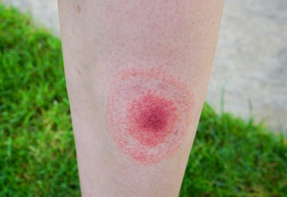 Lyme-kór: oka, tünetei és kezelése