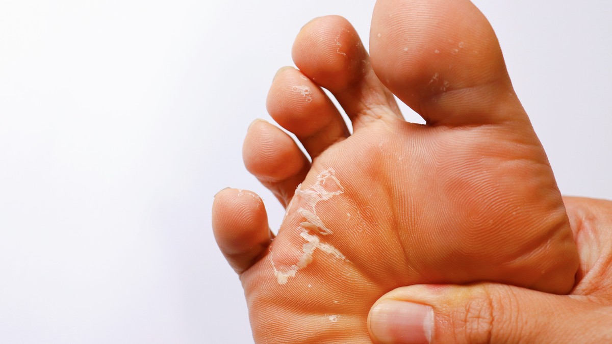 Ljuštenje i perutanje kože na stopalima može biti posledica suve kože, gljivičnih infekcija, dermatoloških oboljenja ili iritacije i opekotina