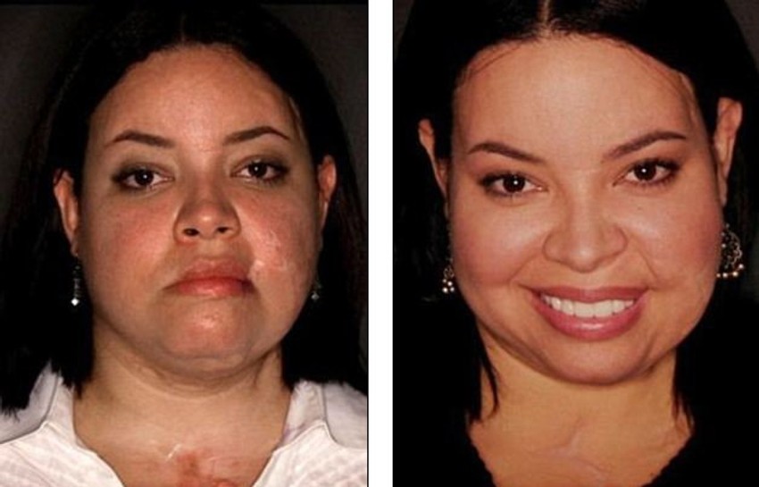 Nizom plastičnih operacija Moralseovoj su uklonjeni veliki ožiljci s lica i vrata