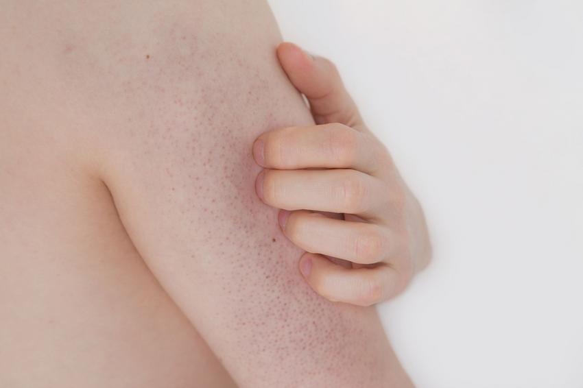 Grízes bőr: a keratosis pilaris oka, tünetei és kezelése | EgészségKalauz