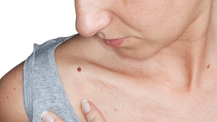 anyajegy, melanoma, daganat, rák