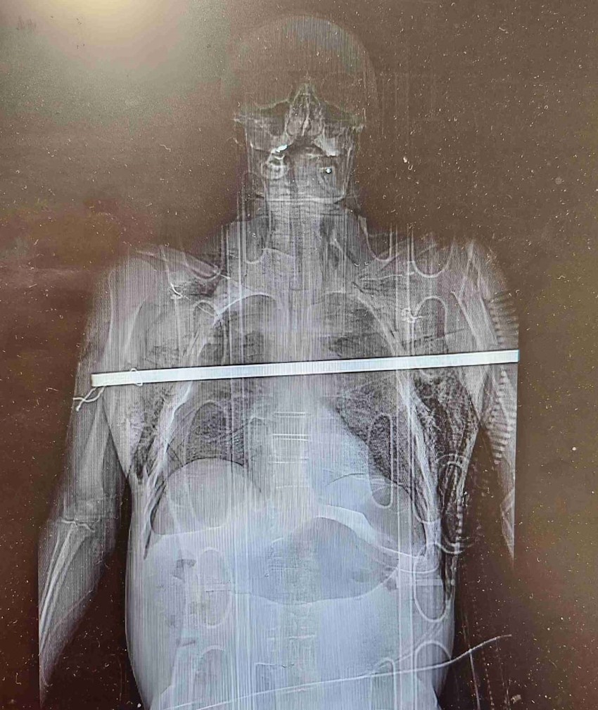 Radovan Kučer kom je šipka probila grudi i pluća