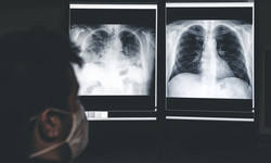 Zbadali płuca osób, które przeszły COVID-19. Zmiany widać nawet po dwóch latach