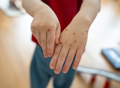 Járvány Ukrajnában: miért veszélyes a Coxsackie-vírus, és miről ismerhetők fel a tünetei? című cikk nyitóképe