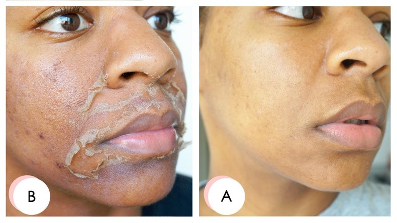 An example of a chemical peel [Healthglow]