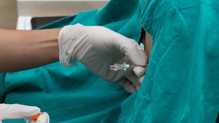 lumbálpunkció agy-gerincvelő folyadék vizsgálat leírás