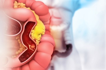 autoimmun betegség, Crohn-betegség, vastagbélrák, daganat, rák, reuma