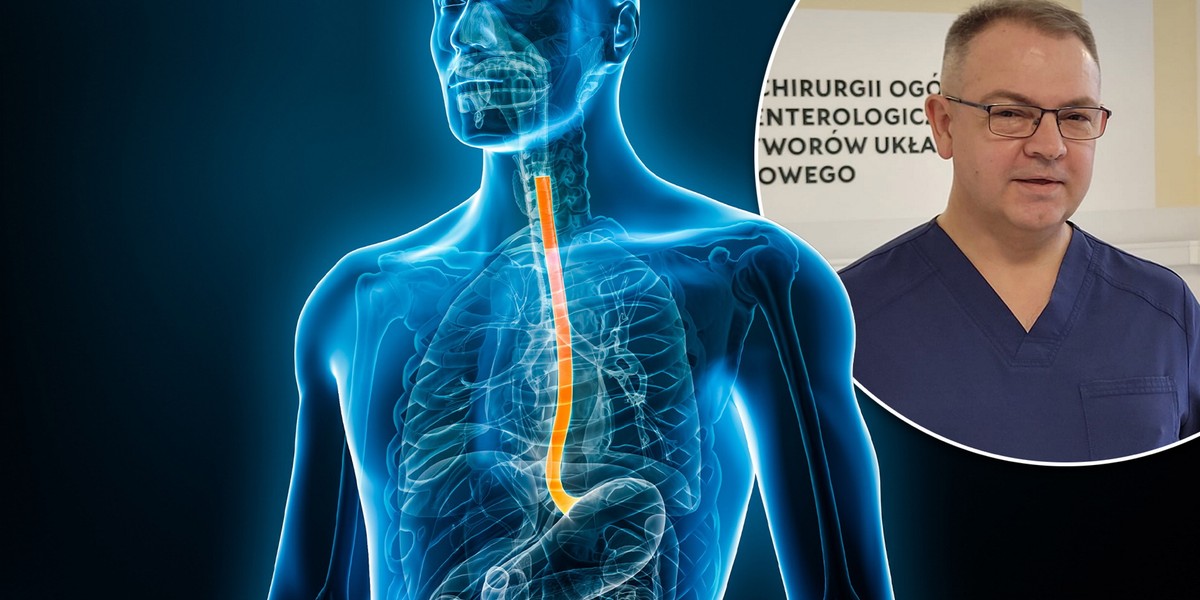 – Nowotwór przełyku jest chorobą rzadką, rocznie w Polsce notowanych jest 1,3 tys. zachorowań, z czego do operacji kwalifikuje się około 200 osób – mówi prof. Tomasz Skoczylas.