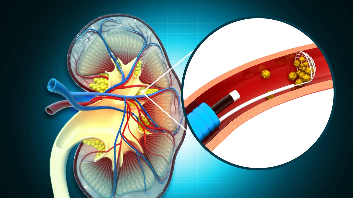 Kamen u bubregu jako boli kada dolazi do njegovog izbacivanja 