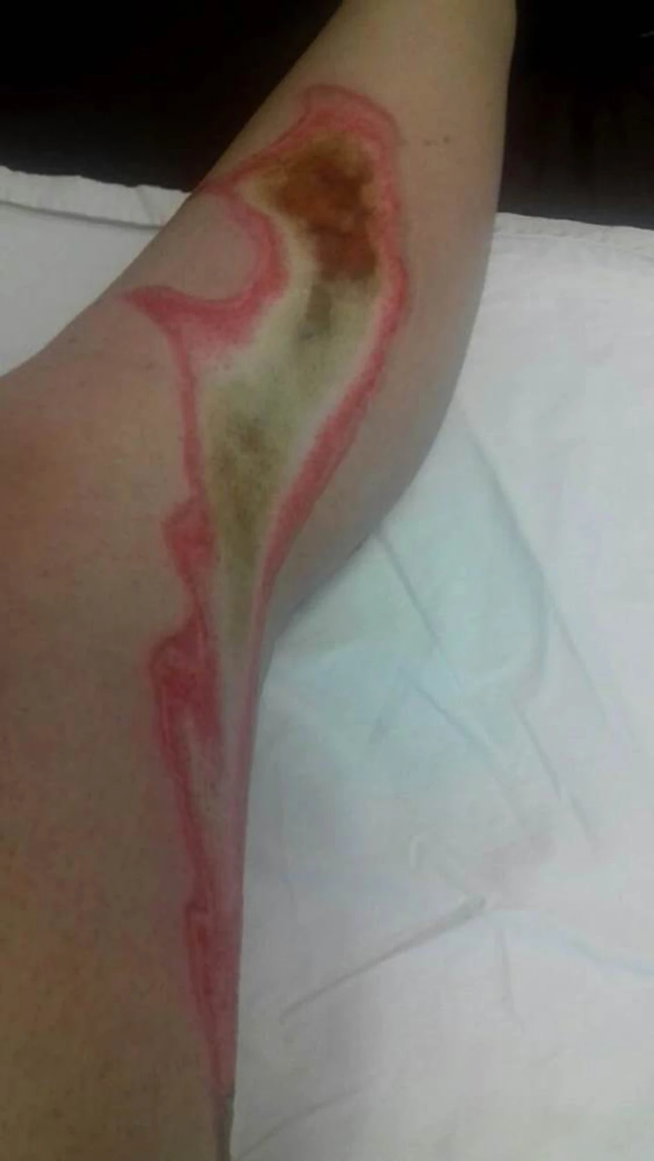 Opekotina koju je Emilija zadobila