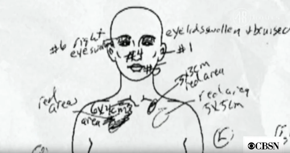 Kejlino telo bilo je puno povreda