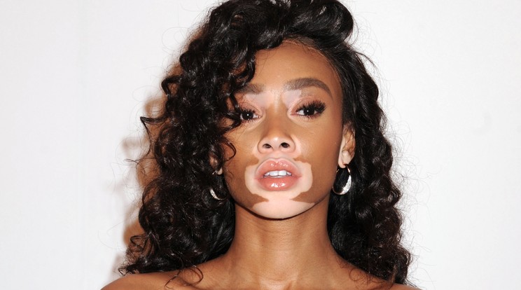 Winnie Harlow/Fotó:northfoto