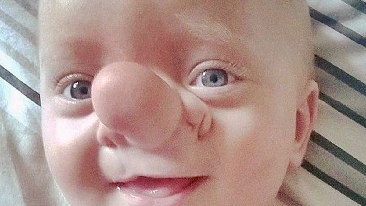 Ollie Trezise ma 21 tygodni i pochodzi z Walii. Chłopiec cierpi na przepuklinę mózgową, która sprawia, że część jego mózgu "wychodzi" z nosa i powoduje deformację czaszki.