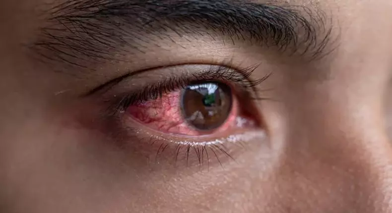 Sudden red eye in the morning could be a sign of conjunctivitis [Depositphotos]