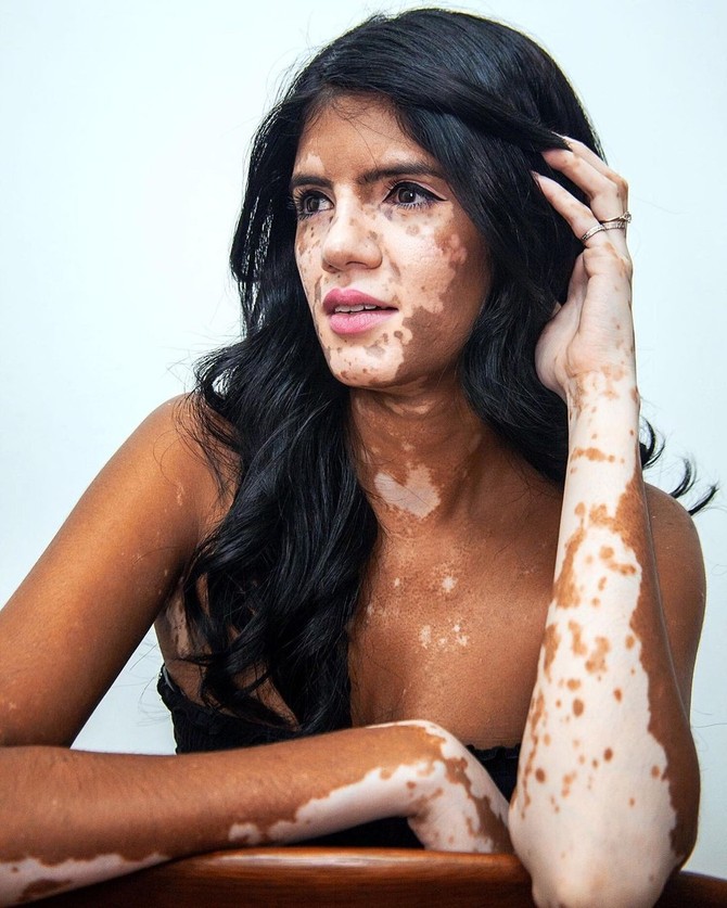 Sonja je model koji ima vitiligo