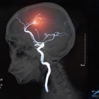 Az ellátás leggyengébb láncszeme: hiányzó rehabilitáció stroke után