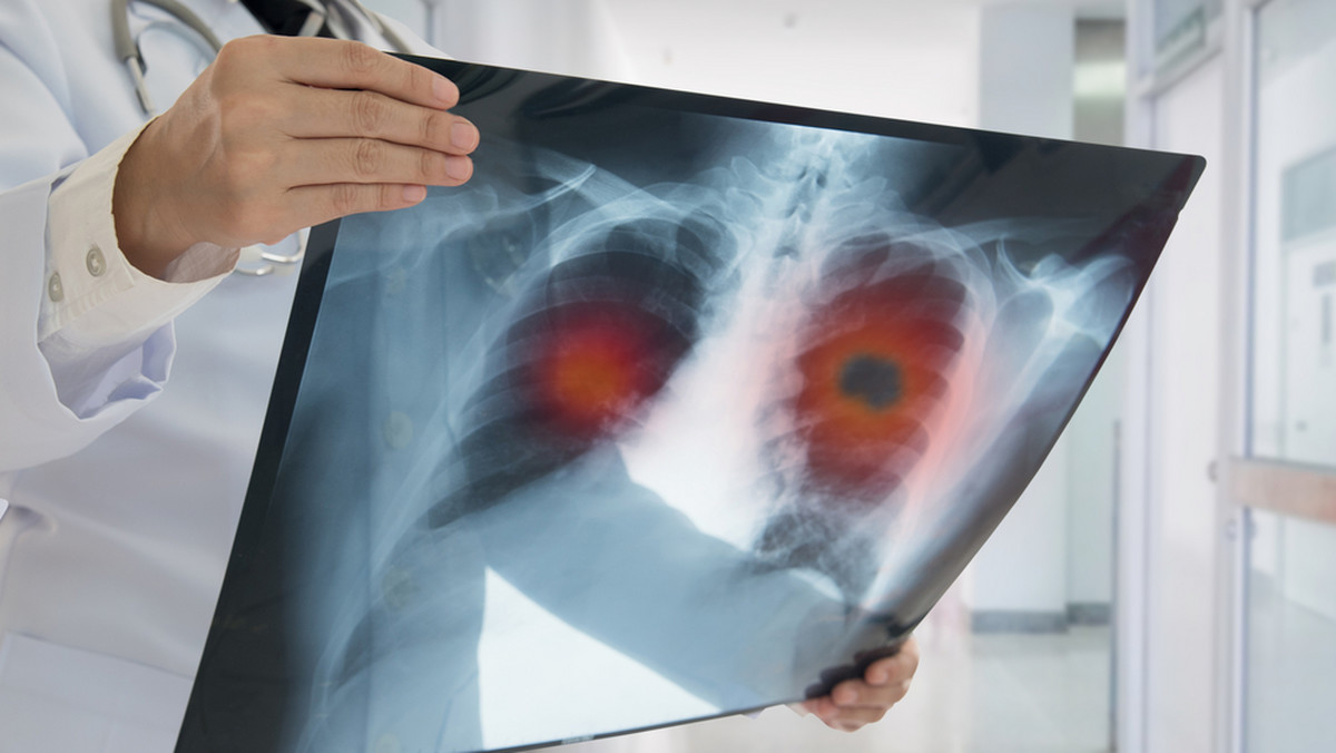 Rak płuca przegapiany w pandemii. Chorzy proszą o spotkanie ministra zdrowia