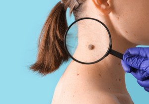 Određene karakteristike mladeža mogu da ukazuju na melanom