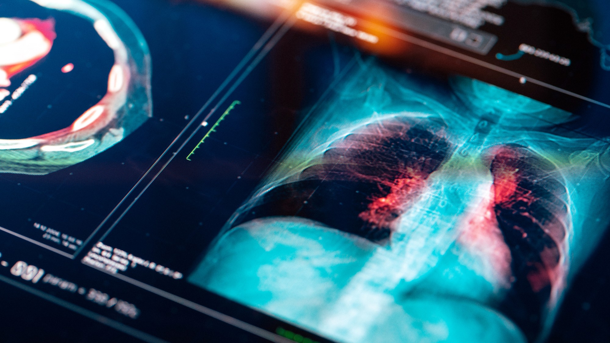 Lekári neskôr zistili, že Gini má zriedkavý typ nemalobunkového karcinómu pľúc . (ilustračné foto).