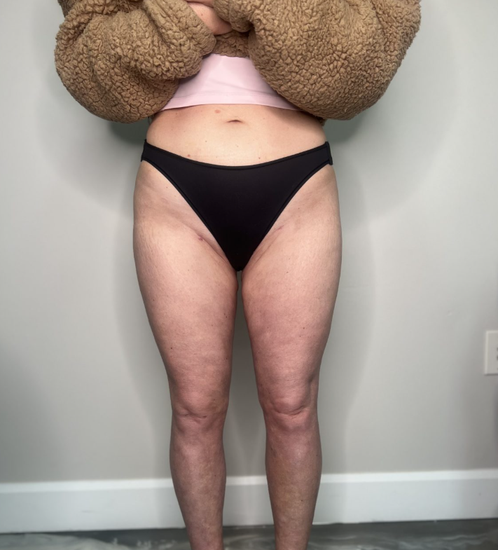 Laura sa nevedela zbaviť tuku na nohách.