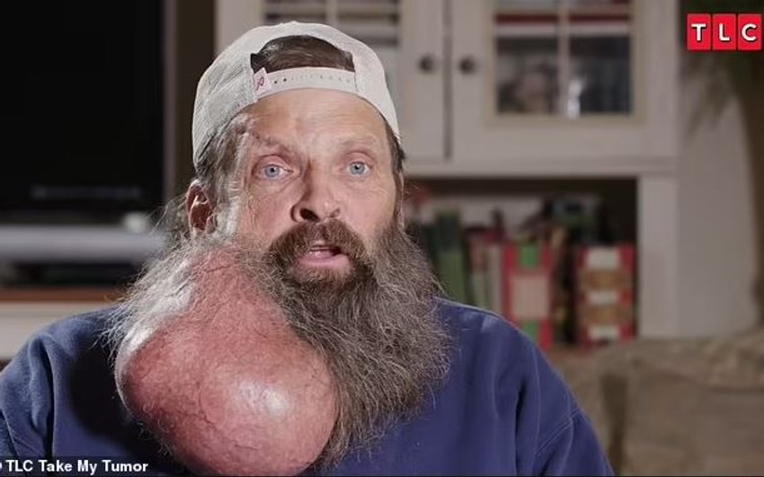 Tumor koji je Tim imao godinama na licu