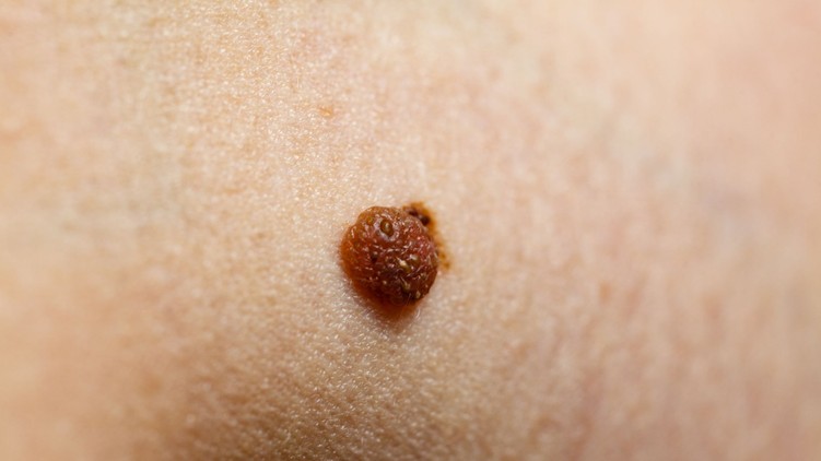 anyajegy, melanoma, bőrrák, tünetei