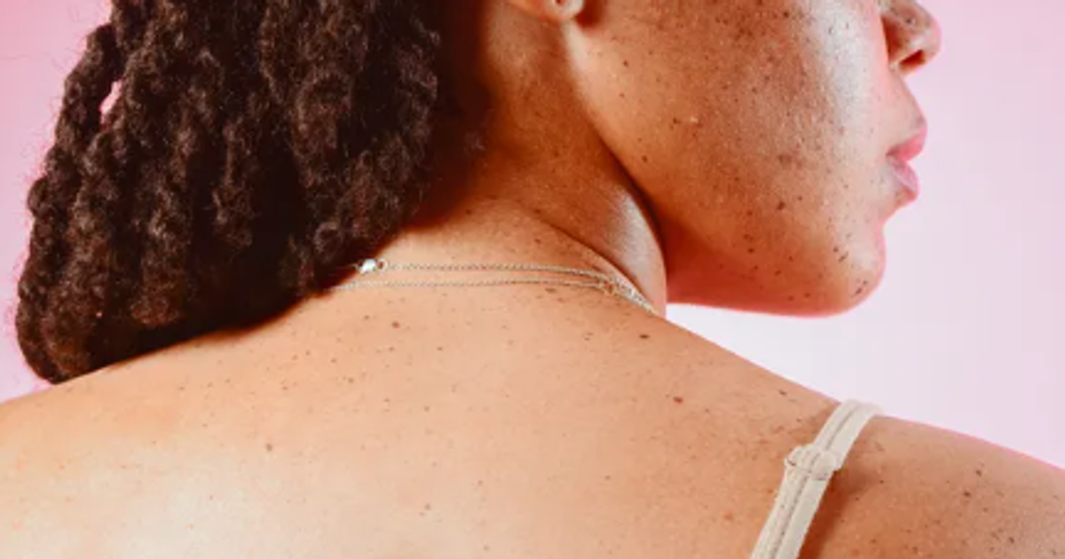Why skin tags develop and how to remove them - Vimarsana News