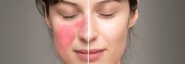 rosacea, bőrbetegség, kipirosodás