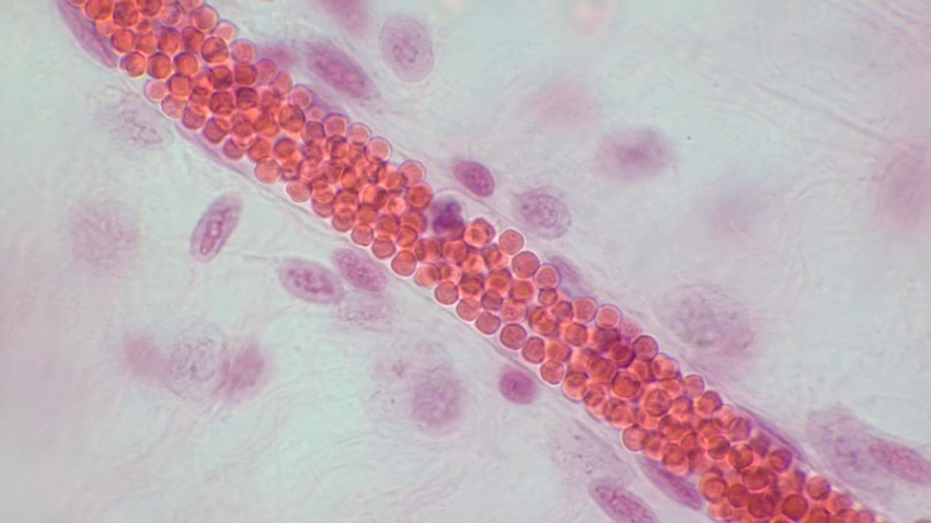 Nije neuobičajeno da osoba ima policitemiju a da nije toga svesna