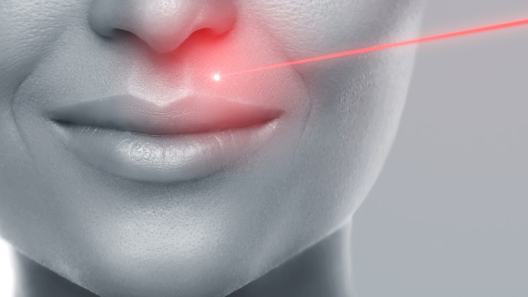 lézeres arcfiatalítás, kezelés, anti-ageing, frakcionált lézeres bőrfiatalítás