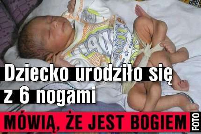 Dziecko urodziło się z 6 nogami. Mówią, że jest bogiem FOTO