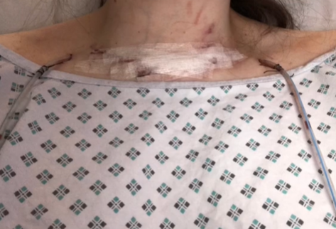 Becky diagnostikovali závažnú rakovinu štítnej žľazy.