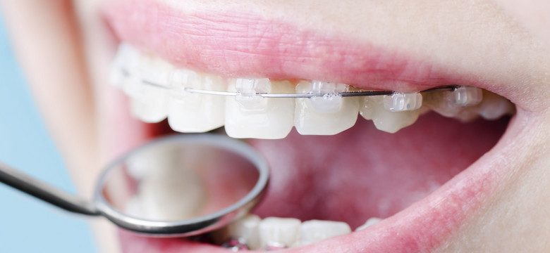 Aparaty ortodontyczne dla dorosłych – jak wybrać właściwy?