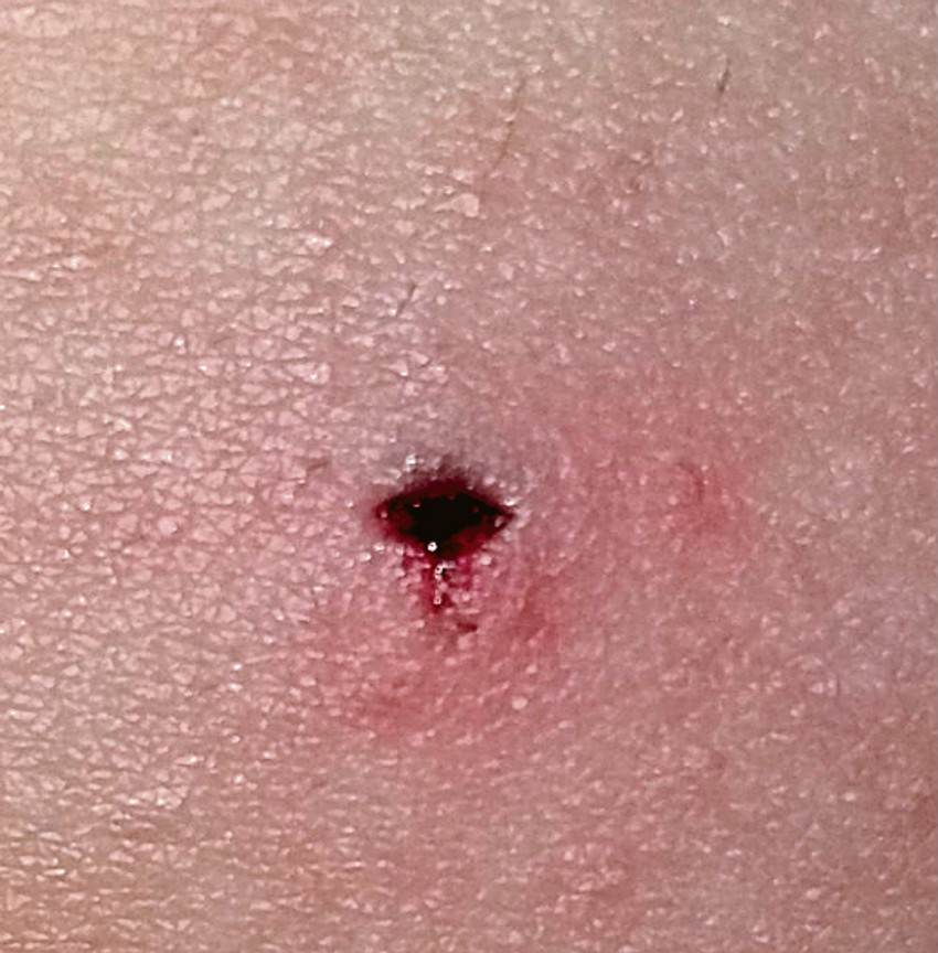 Ubod koji je dečak zadobio u predelu zadnjice