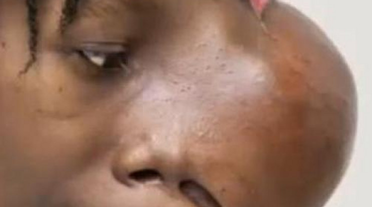 Kétkilós daganatot operáltak ki az arcából –  videó!