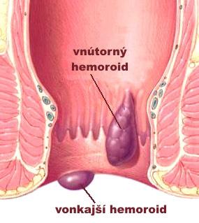 Hemoroidy (zlatá žila) | Najmama.sk