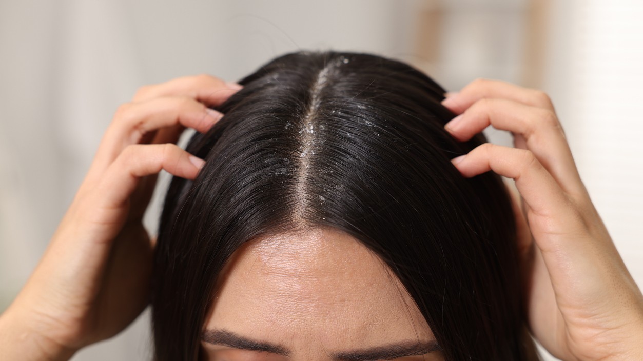 Chrasty a lupiny vo vlasoch sú bežným problémom vlasovej pokožky.