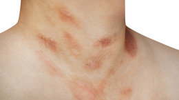 Łupież Gilberta - choroba skóry, która objawia się wysypką i czerwonymi znamionami na ciele