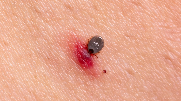 lyme-kór kullancs csípés helye piros