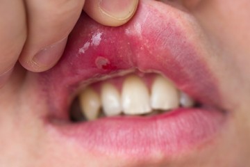 A lakosság közel 90 százaléka herpes simplex vírushordozó, de csak mintegy  1 százalékánál alakul ki ajak- vagy szájüregi gyulladás.