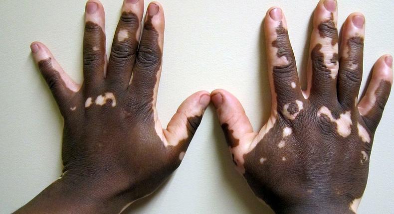 ___6719201___https:______static.pulse.com.gh___webservice___escenic___binary___6719201___2017___5___22___17___Vitiligo2