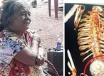 Woman carries dead foetus for 56 years, dies after removal surgery