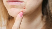 Hormonzavar is okozhatja, ha így néz ki az arcbőre című cikk nyitóképe