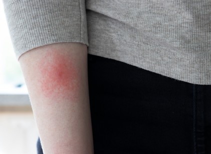 Ezért olyan nehéz időben diagnosztizálni a Lyme-kórt című cikk nyitóképe