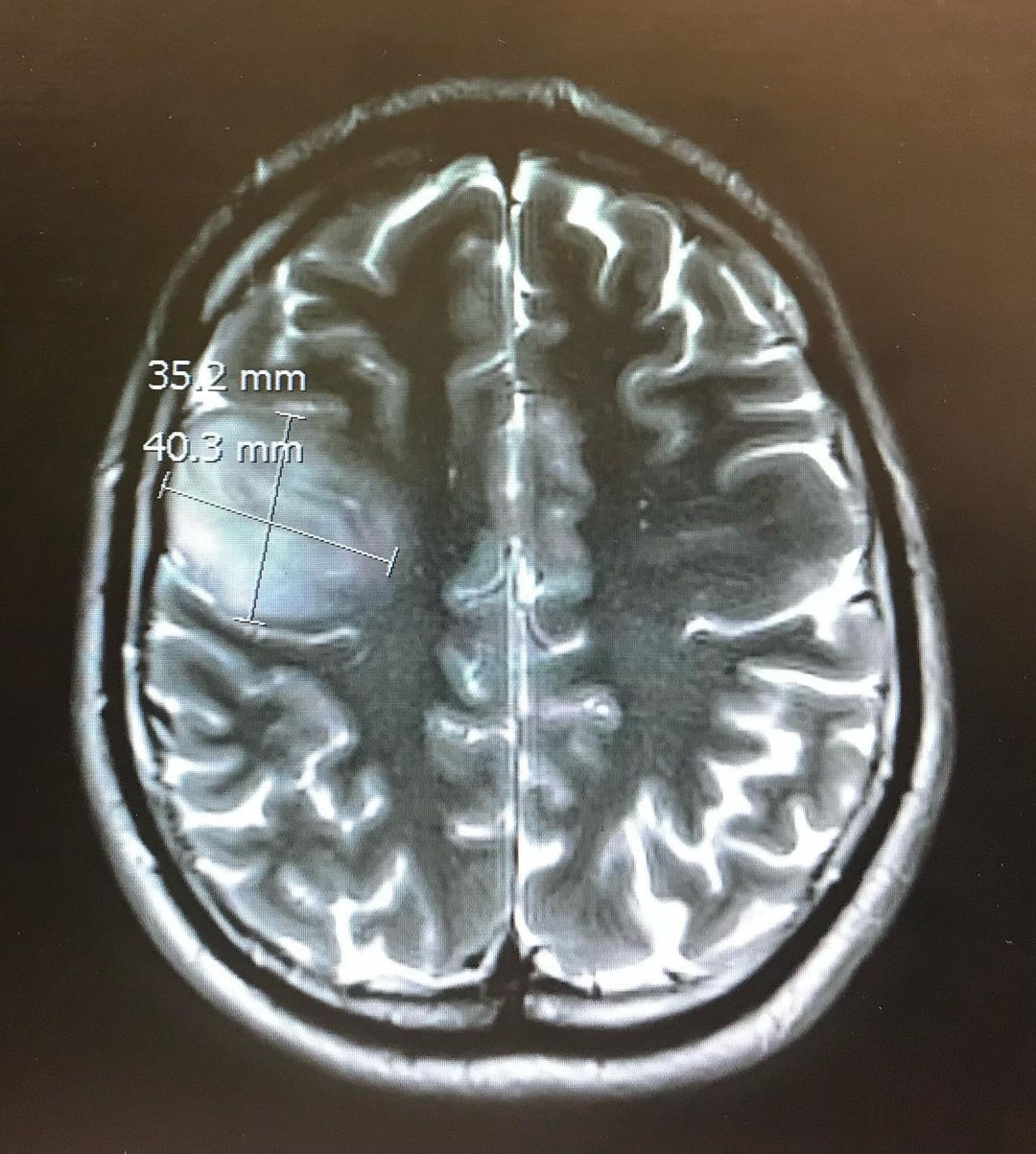Muž mal osem rokov nediagnostikovaný nádor.