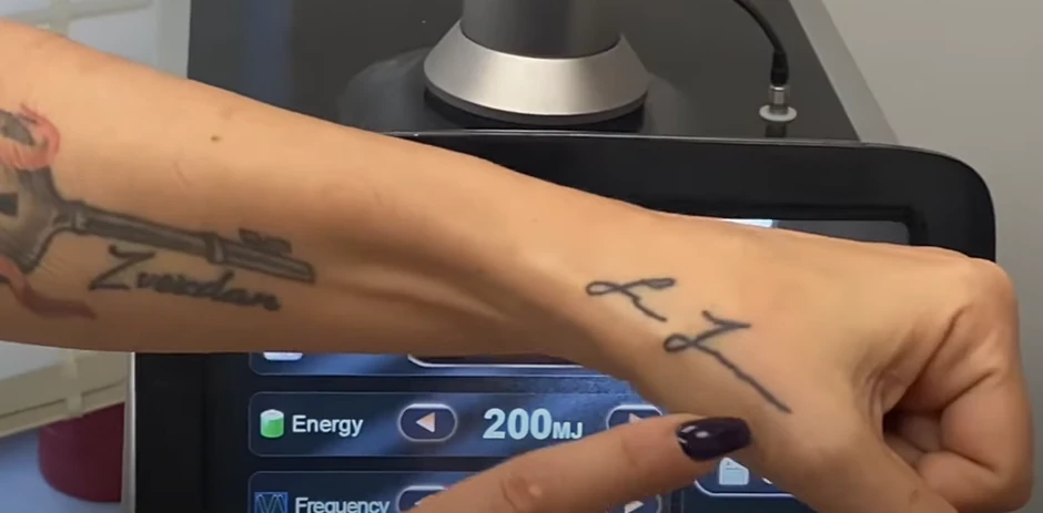 Ana Ćurčić uklonila tetovažu koju je posvetila Zvezdanu Slavniću