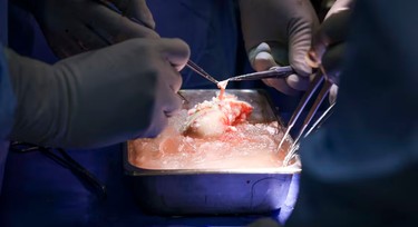 How doctors transferred pig's kidney into human patient for the first time