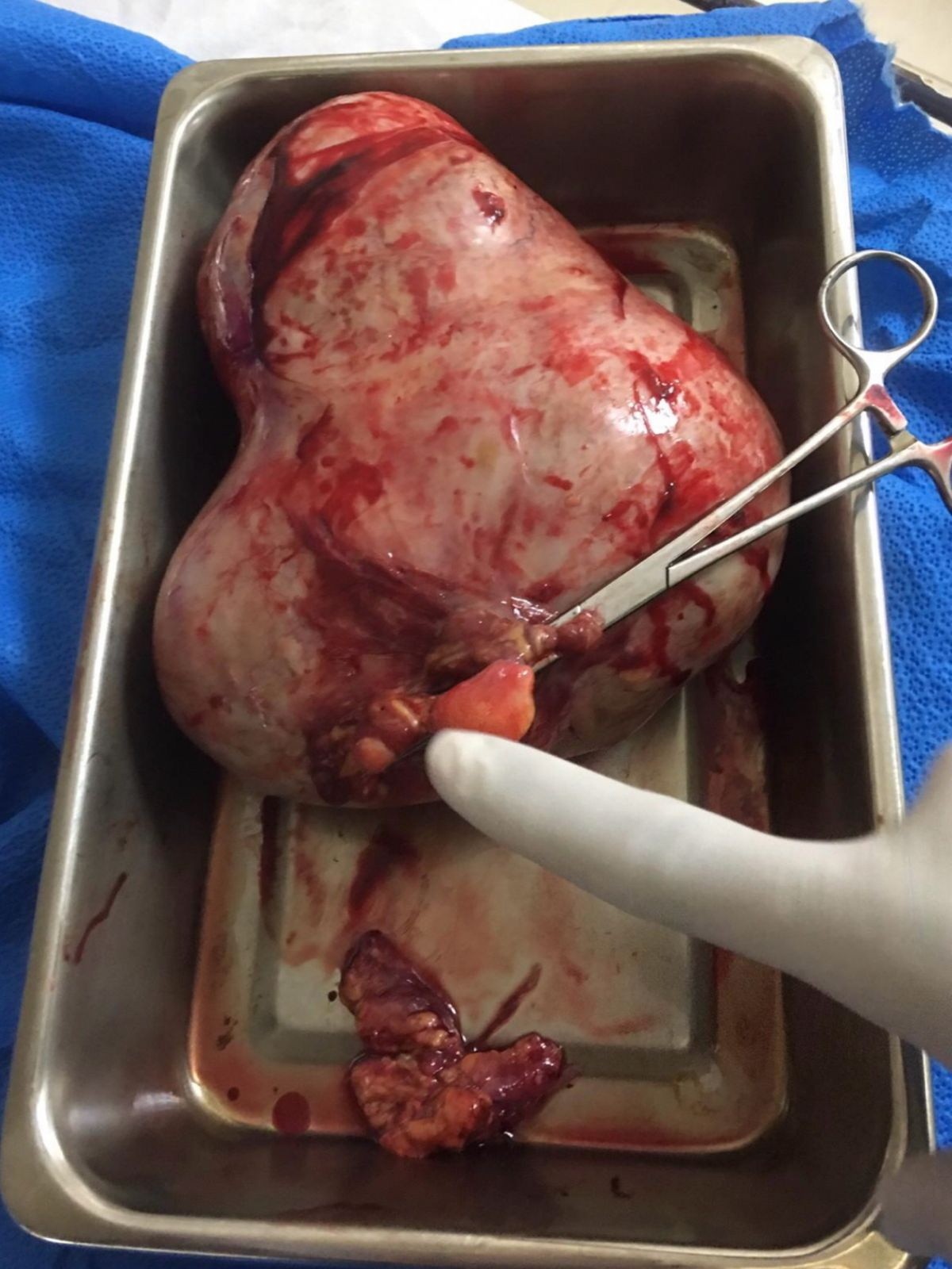 Ruby-Mae vyoperovali veľký tumor.