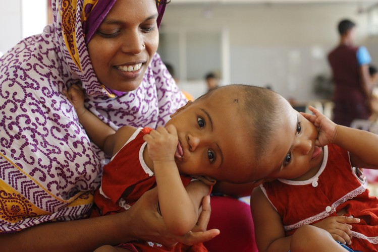 DZIEWCZYNKI ZŁĄCZONE GŁÓWKAMI. ZDOŁAJĄ JE ROZDZIELIĆ?