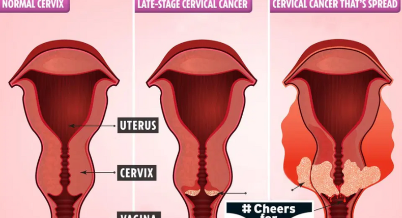 3 ways you can detect cervical cancer early and increase survival rate. [thesun]